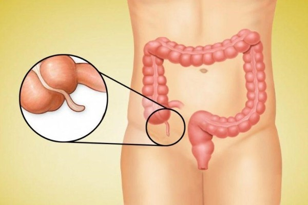 Appendicectomy Surgery