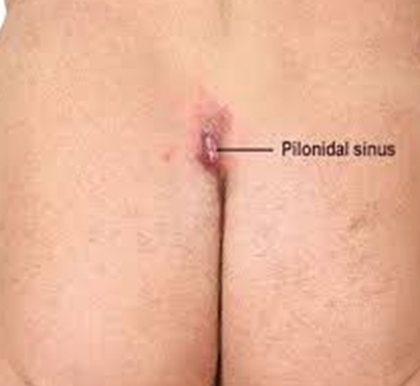Dr. Sangeeta Panigrahi – Pilonidal Sinus Doctor Andheri East