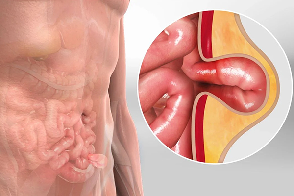 Recurrent Hernia