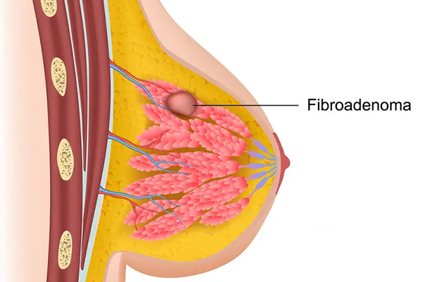 Fibroadenoma Removal
