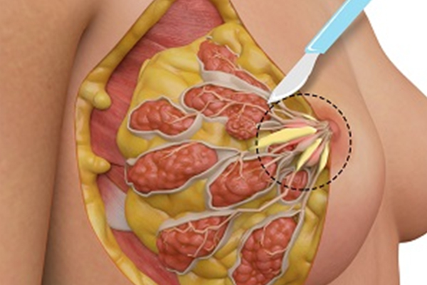 Ductal Ectasia