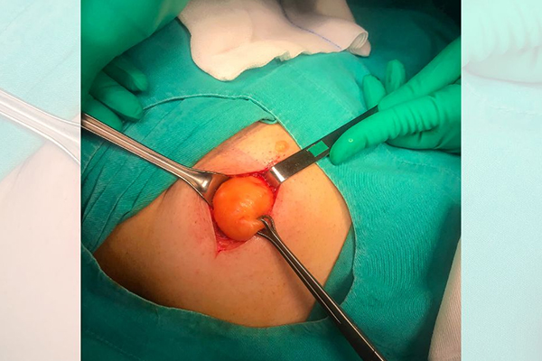 Sebaceous Cyst Removal