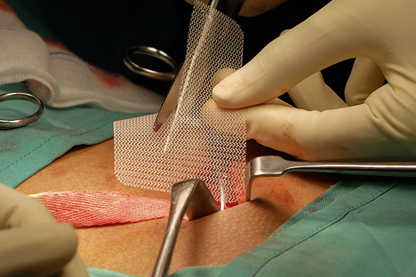 Hernia Repair