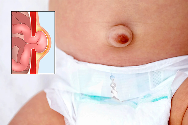 Umbilical Hernia